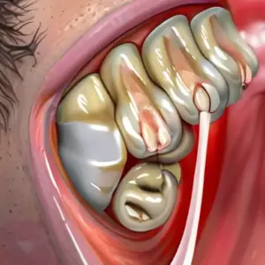 Скуловая имплантация (Zygoma): решение для пациентов с критической атрофией костной ткани верхней челюсти