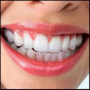 Десневая улыбка (Gummy Smile): методы хирургической коррекции
