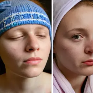 Обострение атопического дерматита (экземы) в холодное время: восстановление липидного барьера кожи с помощью аптечных эмолентов