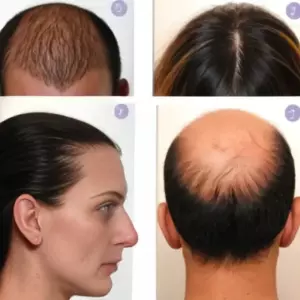 Диффузная и андрогенетическая алопеция: пошаговый алгоритм поиска внутренних причин интенсивного выпадения волос