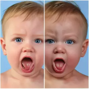 Подрезание уздечки языка у новорожденных: показания