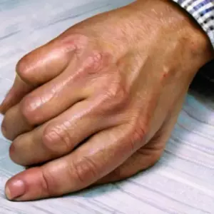 Хрустеть пальцами вредно? Что говорят исследования о связи с артритом
