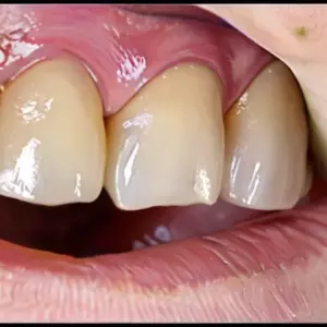 Детские циркониевые коронки (NuSmile, Zirconia): максимально эстетичное и прочное восстановление разрушенных молочных моляров