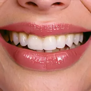 Компьютерное моделирование улыбки (Digital Smile Design - DSD): цифровая примерка формы и цвета будущих виниров до начала обточки зубов